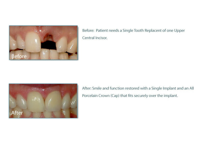 before and after picture of a patient with dental implant and crown