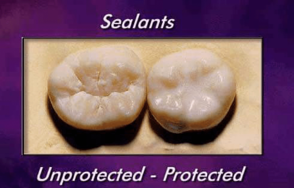 What are Dental Sealants? Fixari Family Dental